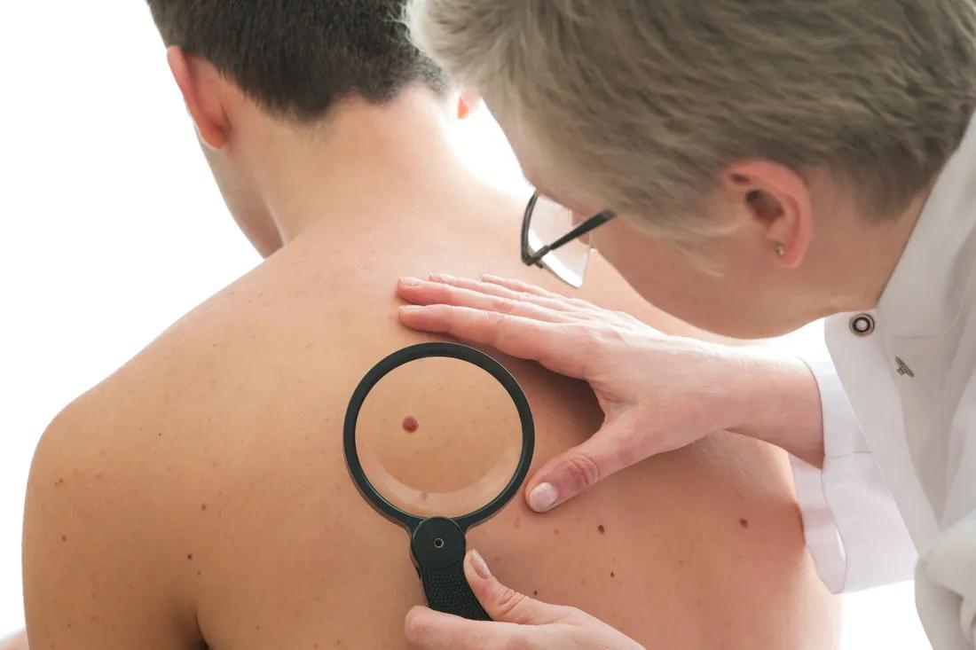 Skin Check: Why Regular Skin Checks Could Save Your Life